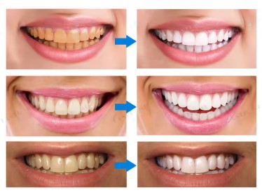 Dazzling White Lapiz Blanqueador Denta
